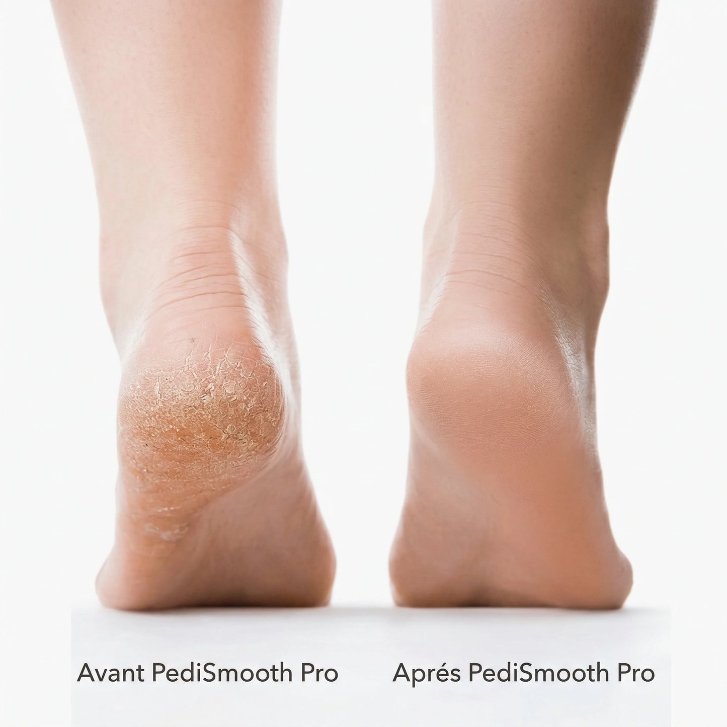 Noravio™ PediSmooth Pro